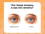 Почему появился ячмень в глазу и что с ним делать? 