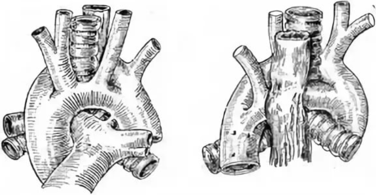 Сосудистое кольцо двойная дуга аорты. Аномалии развития дуги аорты. Персистирование обеих дуг аорты.