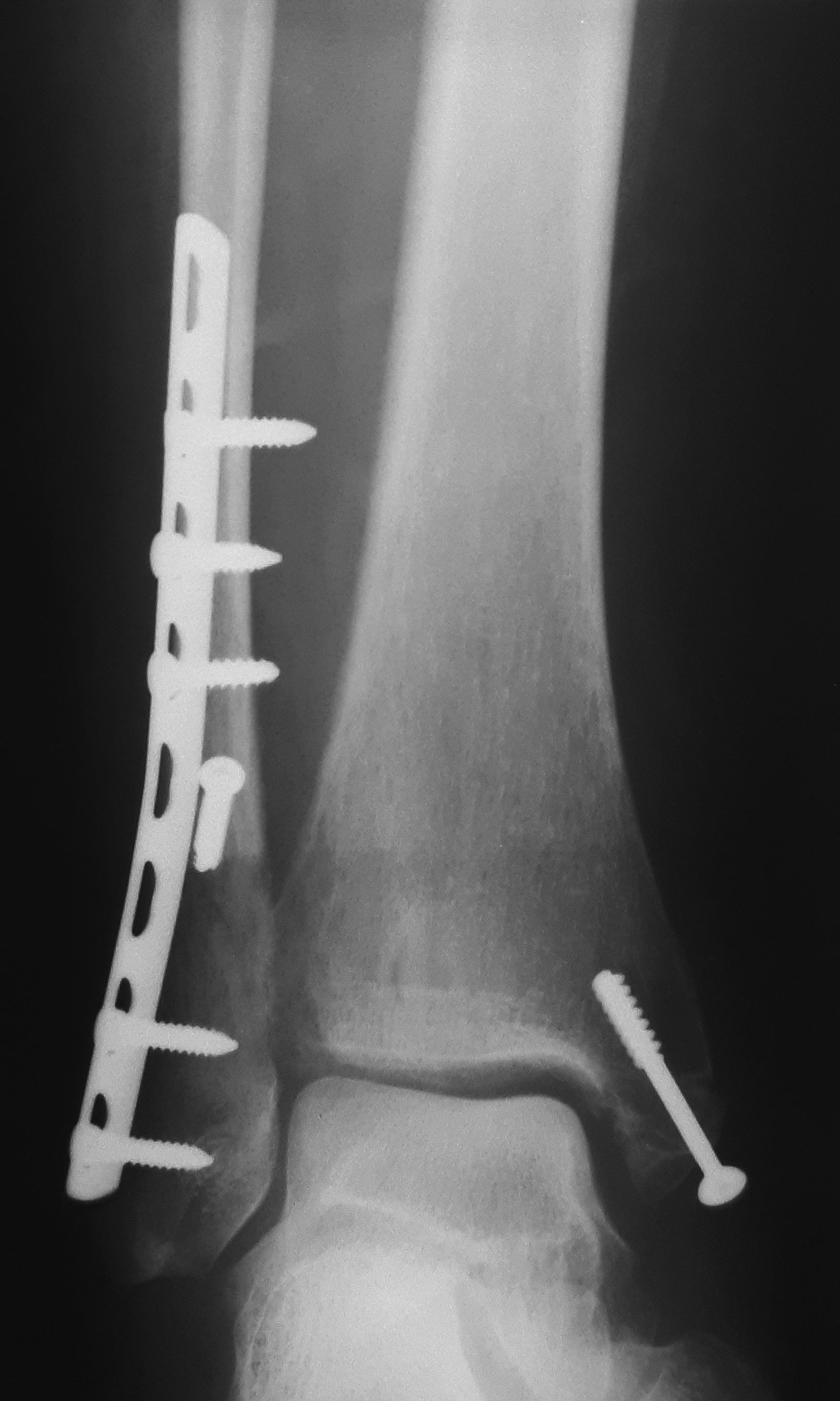 Пластина после перелома ноги. Перелом лодыжки с остеосинтезом. Остеосинтез трехлодыжечный перелом. Внутрикостный остеосинтез лодыжки. Остеосинтез лодыжки позиционный винт.